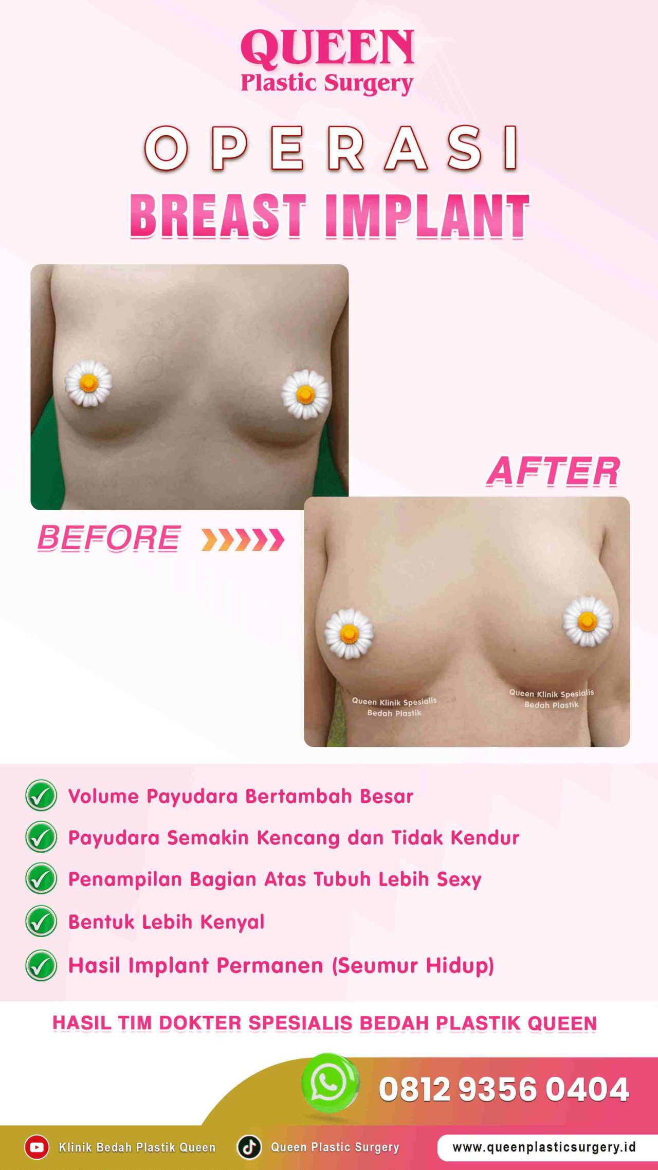 Hasil Breast Implant Queen Plastic Surgery, foto 28