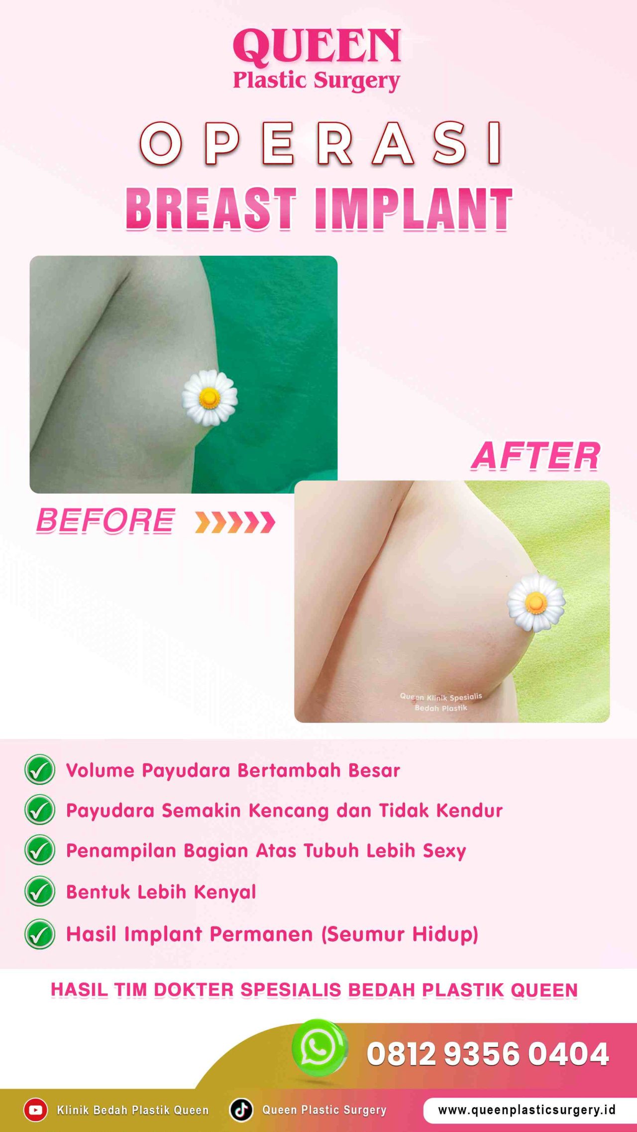 Sebelum-&-Sesudah-OP-Breast-Implant-Queen-002 (1)-fotor-20240129154541