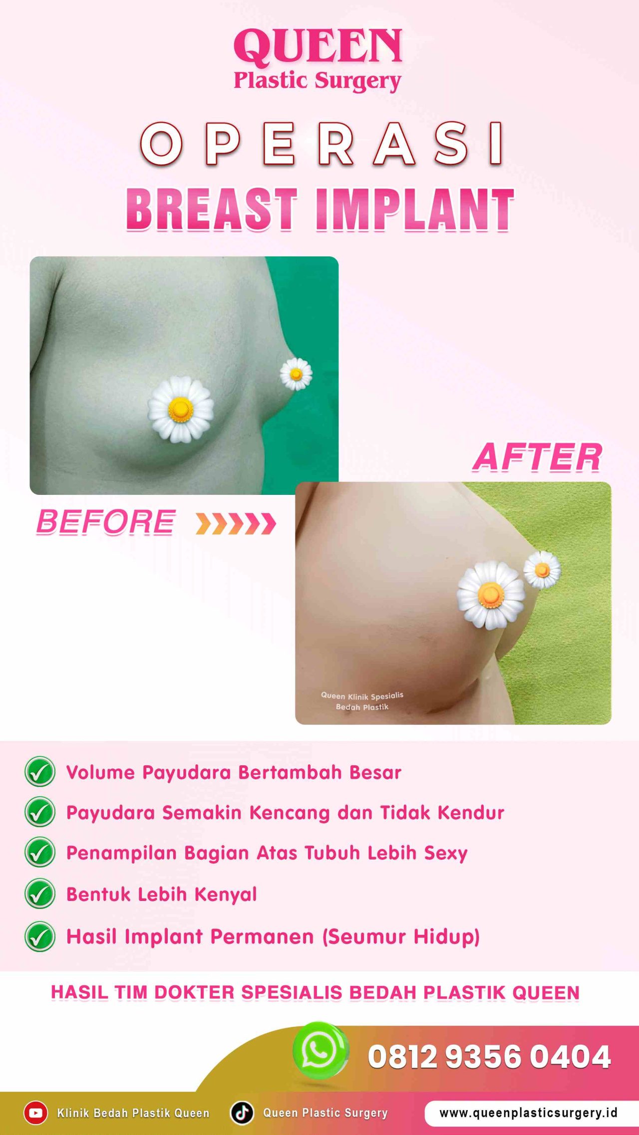 Hasil Breast Implant Queen Plastic Surgery, foto 23