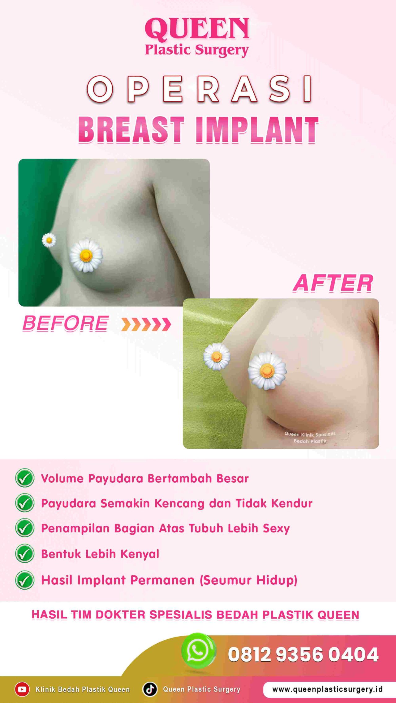 Hasil Breast Implant Queen Plastic Surgery, foto 19