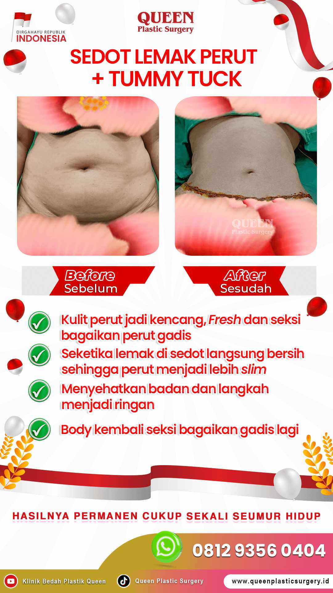 Sedot-Lemak-+-Tummy-Tuck-IGS-03 (1)-fotor-20240129141420