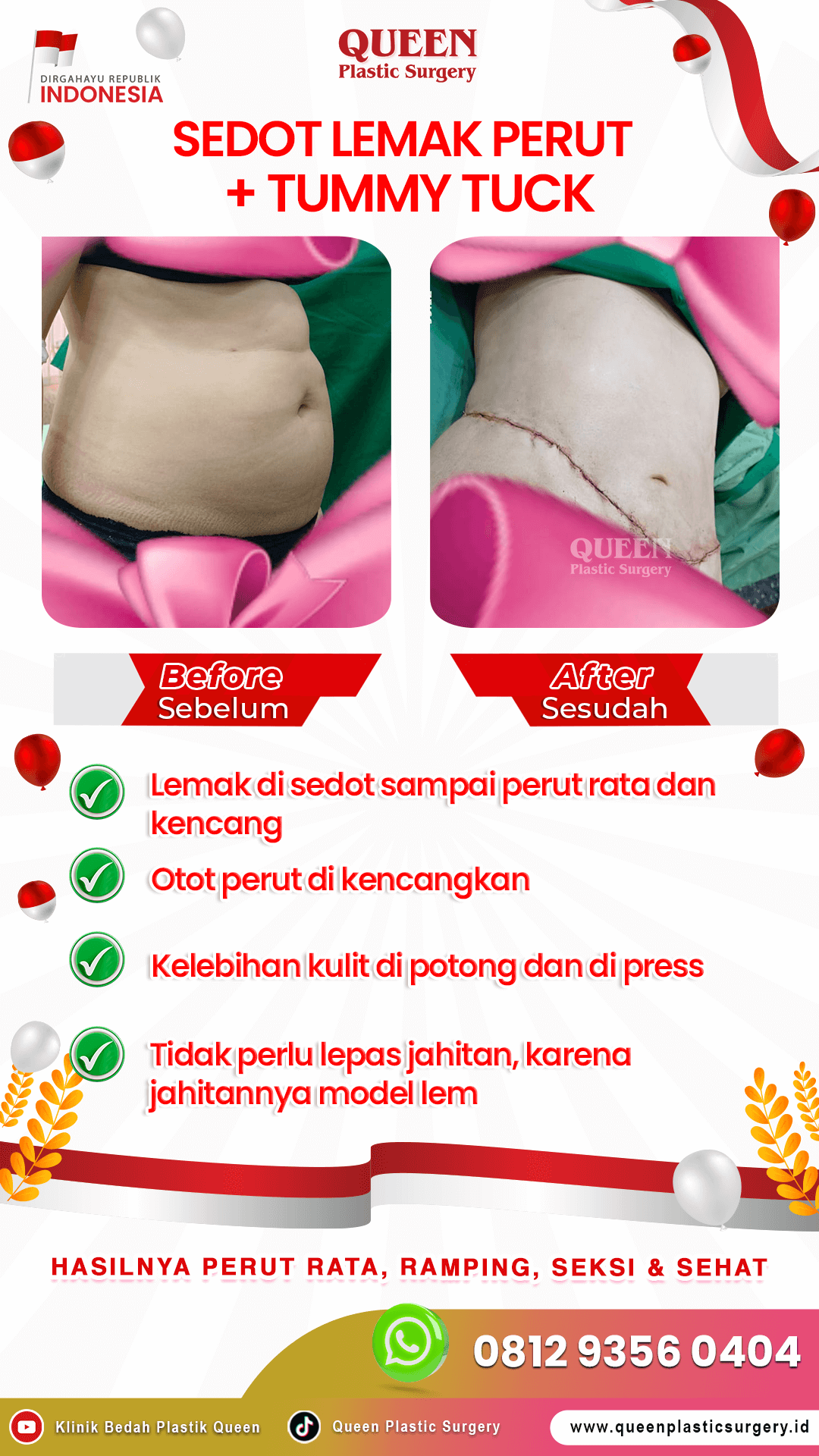 Sedot-Lemak-+-Tummy-Tuck-IGS-04 (3) (1)