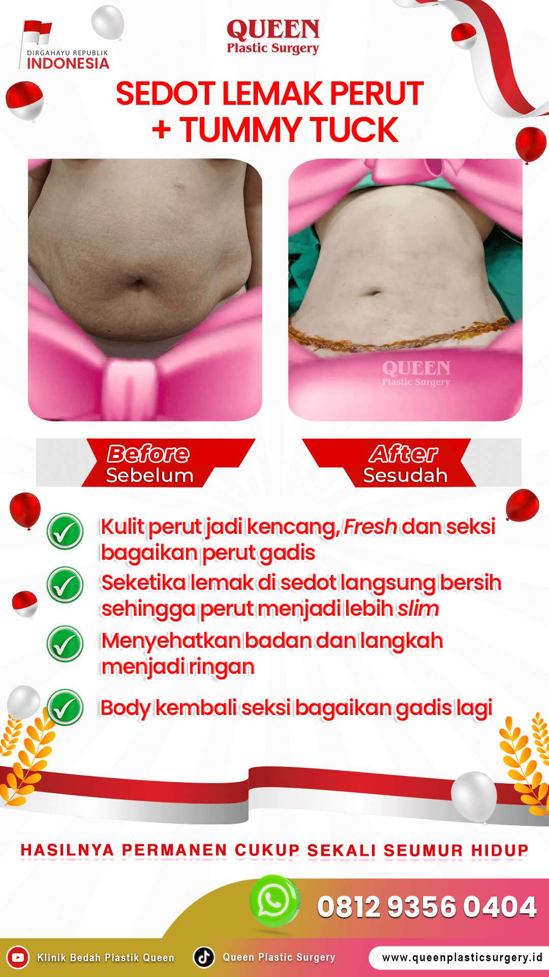 Sedot-Lemak-+-Tummy-Tuck-IGS (1)-fotor-20240129141551