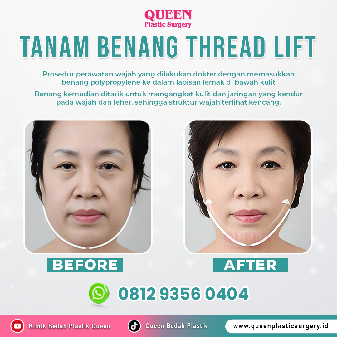 https://queenplasticsurgery.id/wp-content/uploads/2024/01/Tanam-Benang-Thread-Lift.jpg
