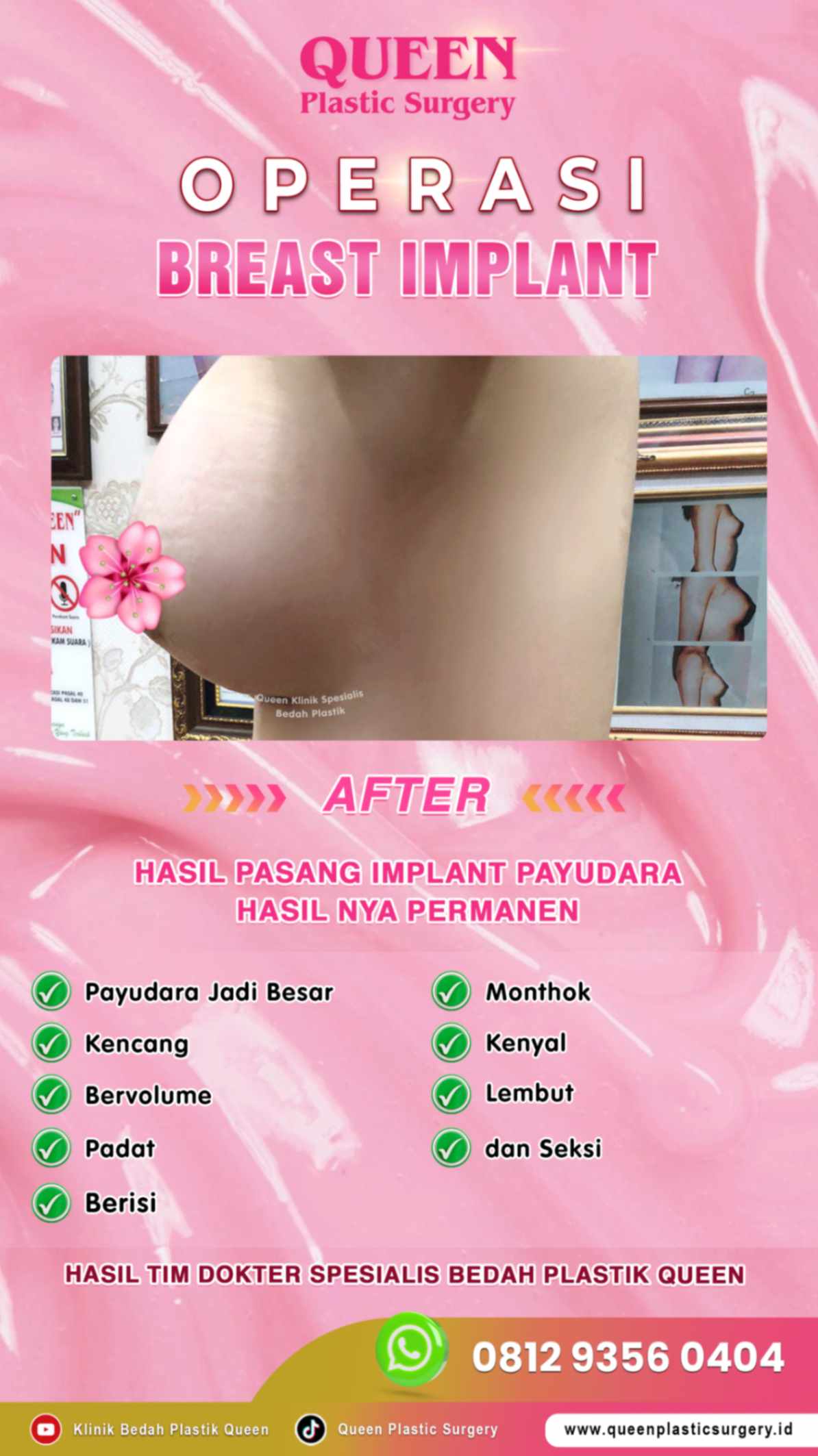 Hasil Breast Implant Queen Plastic Surgery, foto 57