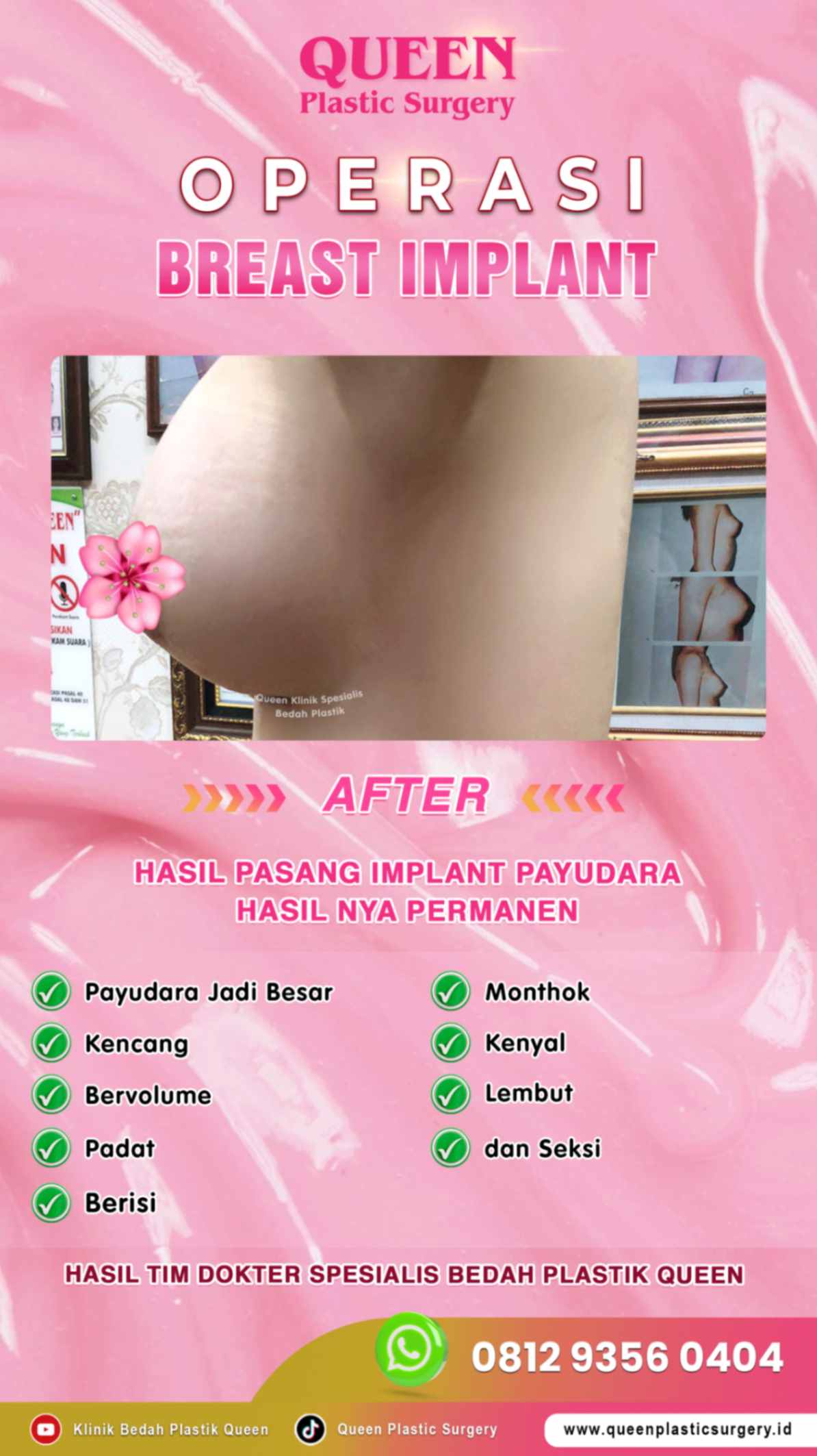 Hasil Breast Implant Queen Plastic Surgery, foto 58