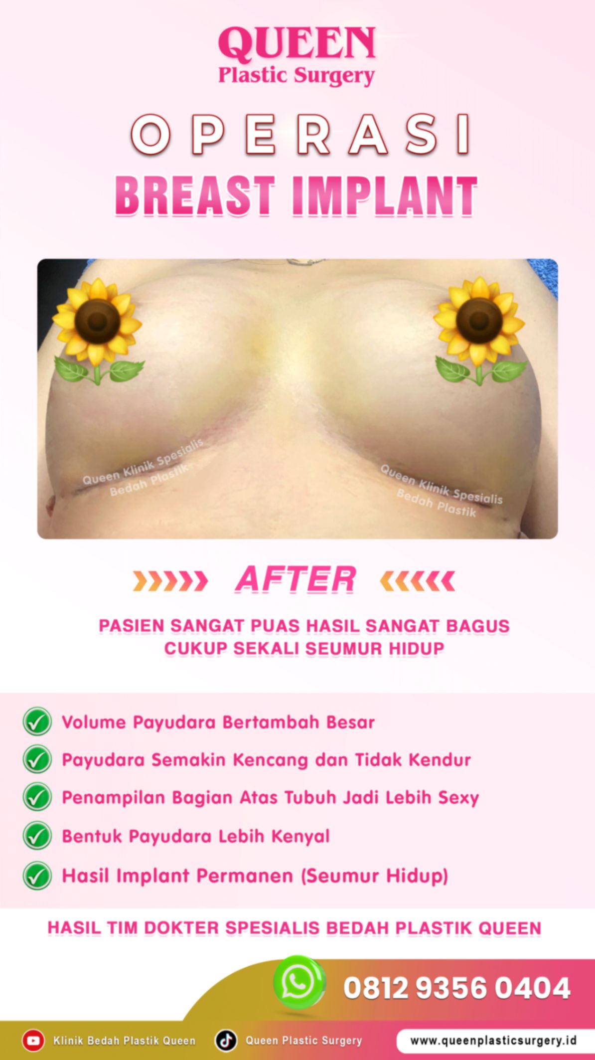 Hasil Breast Implant Queen Plastic Surgery, foto 60