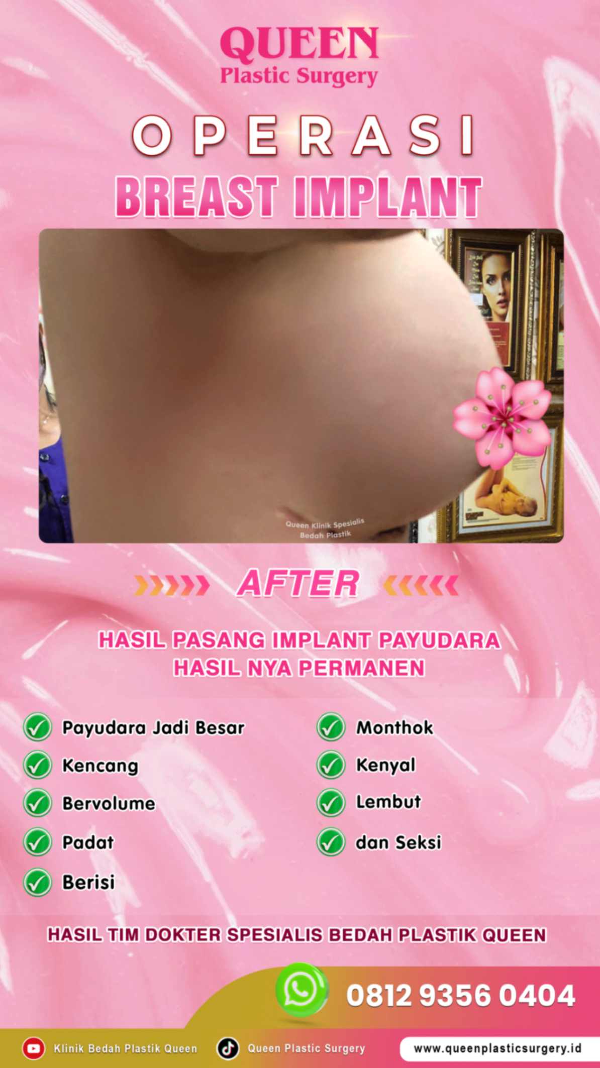 after-breast-implant-hasil-memuaskan-004 (2) (1)_batcheditor_fotor-fotor-2024012518512