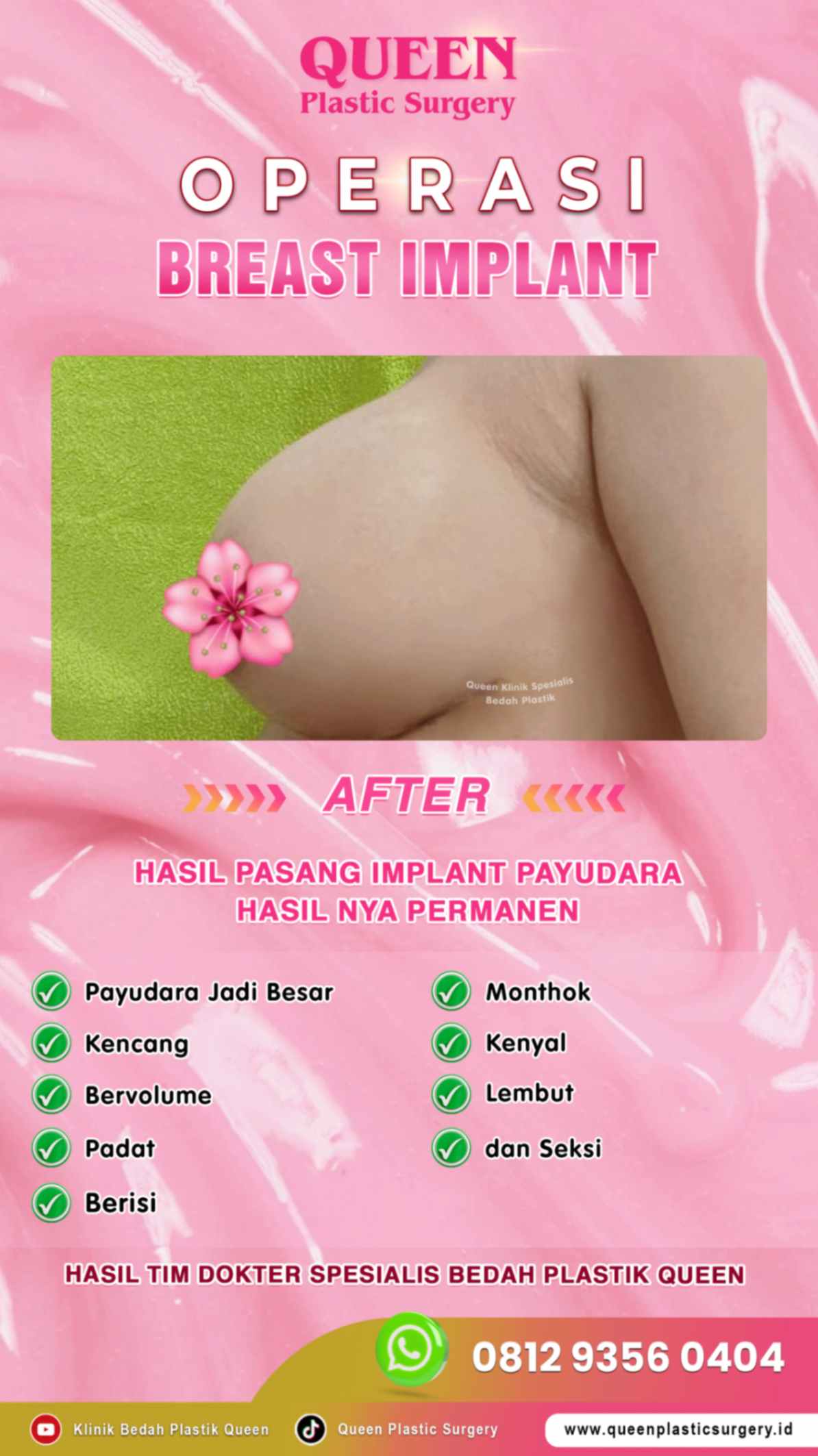 Hasil Breast Implant Queen Plastic Surgery, foto 40