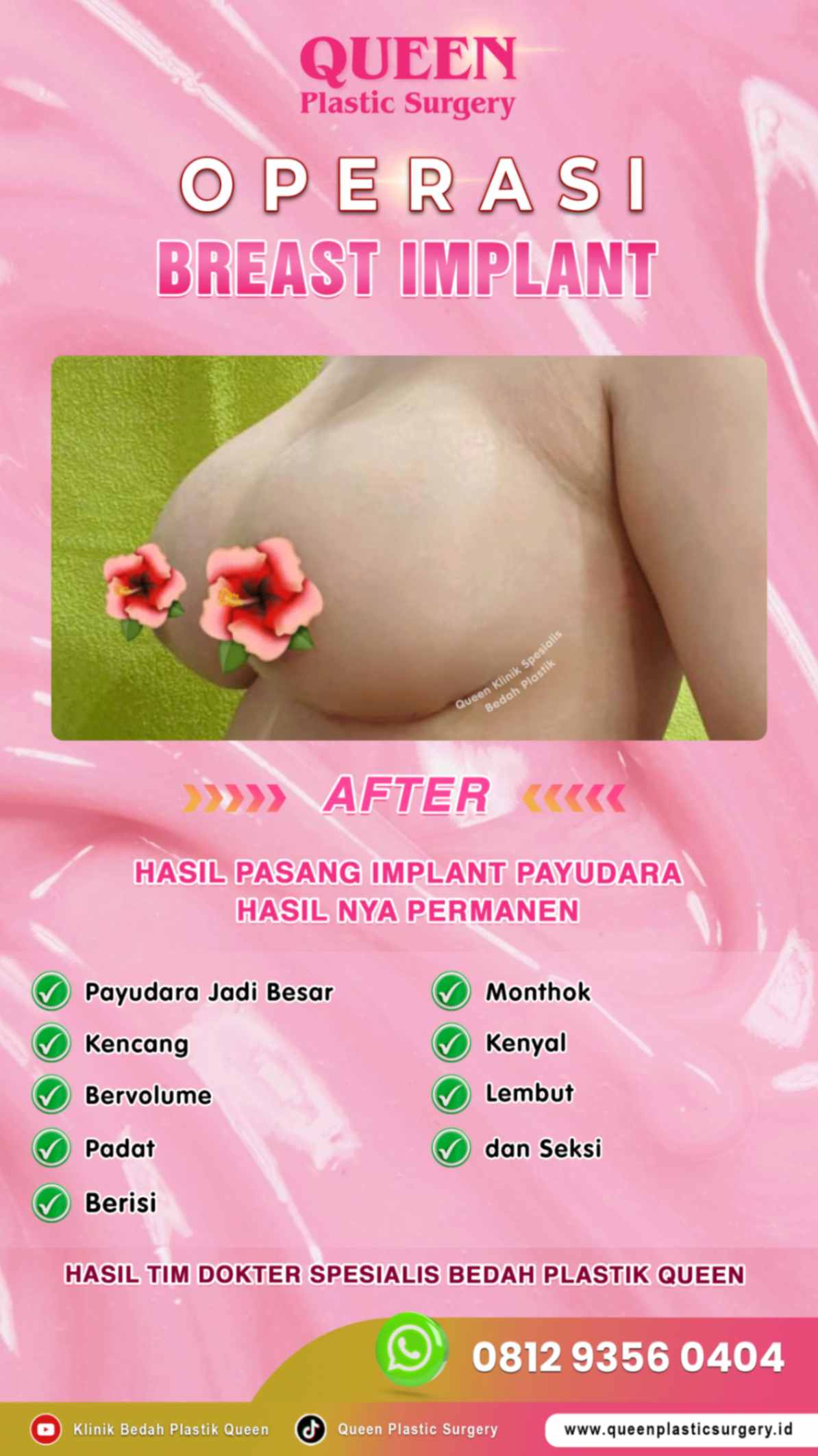 Hasil Breast Implant Queen Plastic Surgery, foto 43