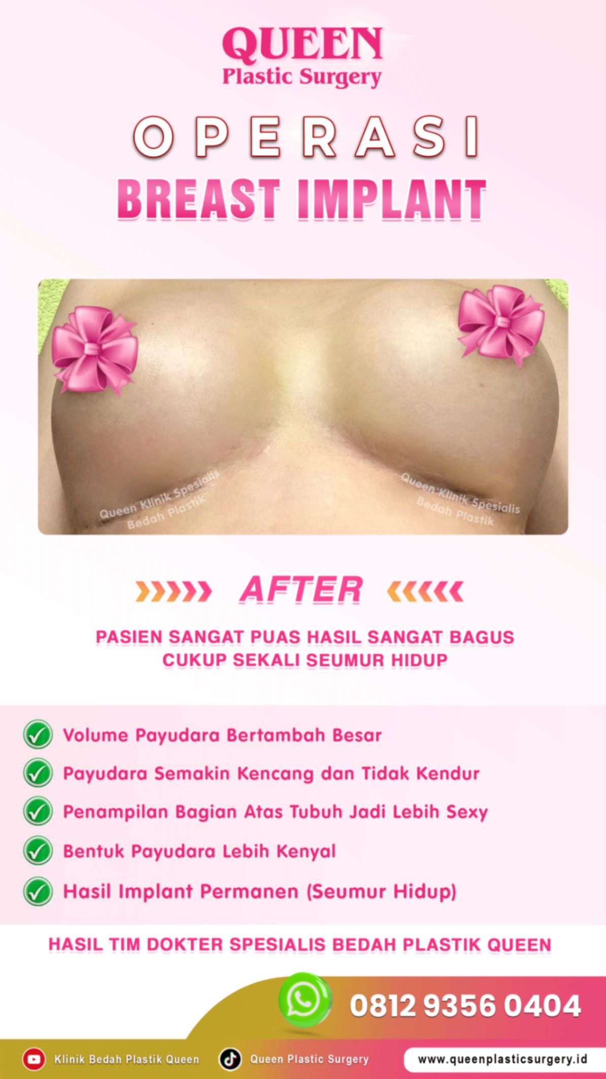 Hasil Breast Implant Queen Plastic Surgery, foto 4