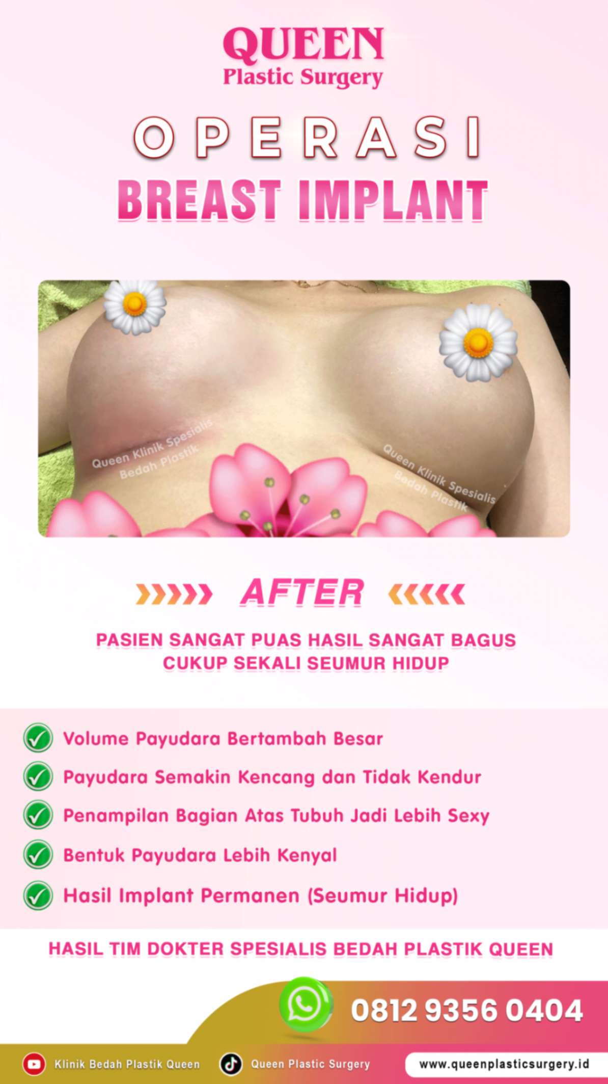 after-breast-implant-hasil-memuaskan-010 (2) (1)_batcheditor_fotor-fotor-20240125185326