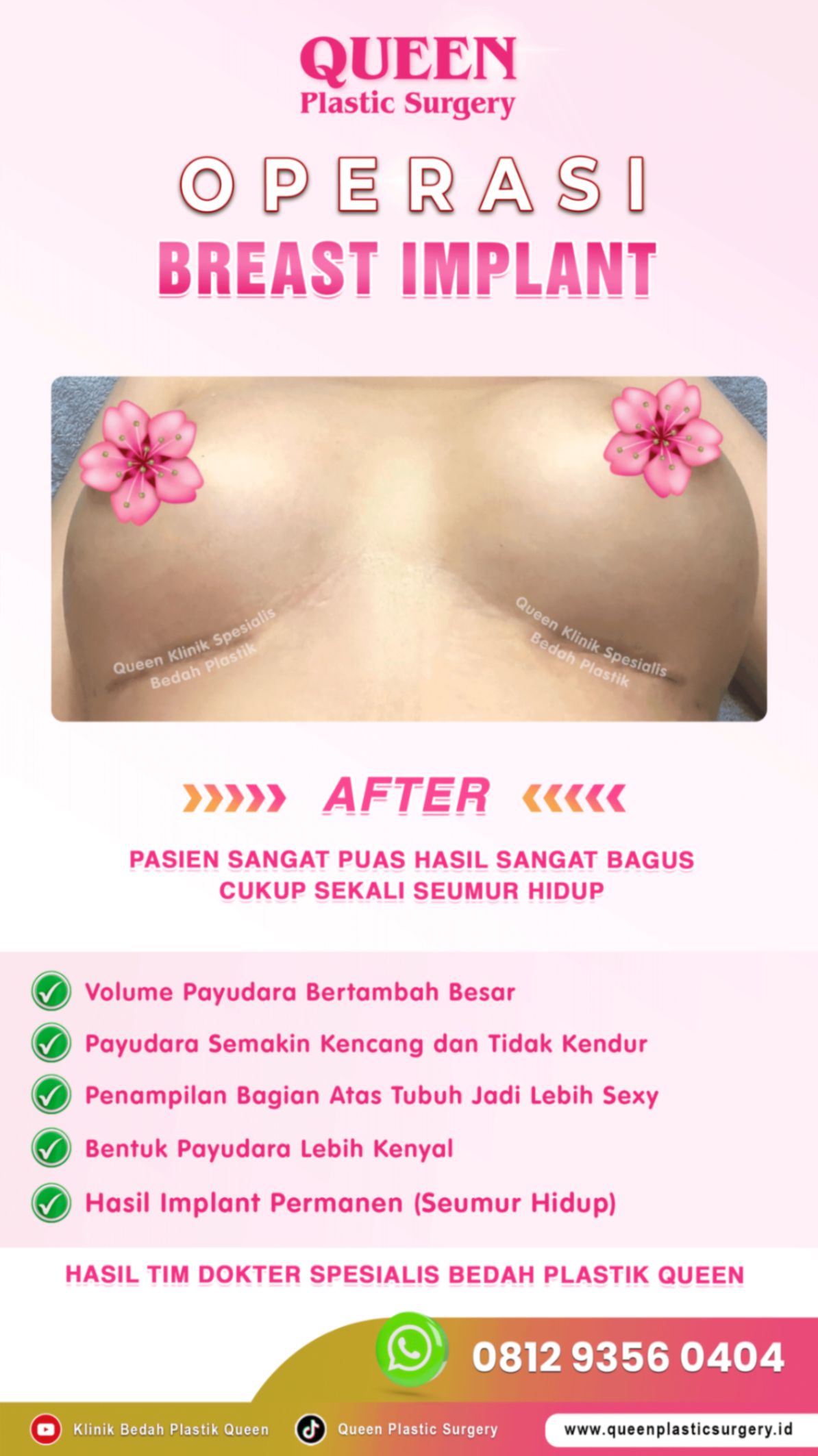 after-breast-implant-hasil-memuaskan-011 (1)_batcheditor_fotor-fotor-2024012518560