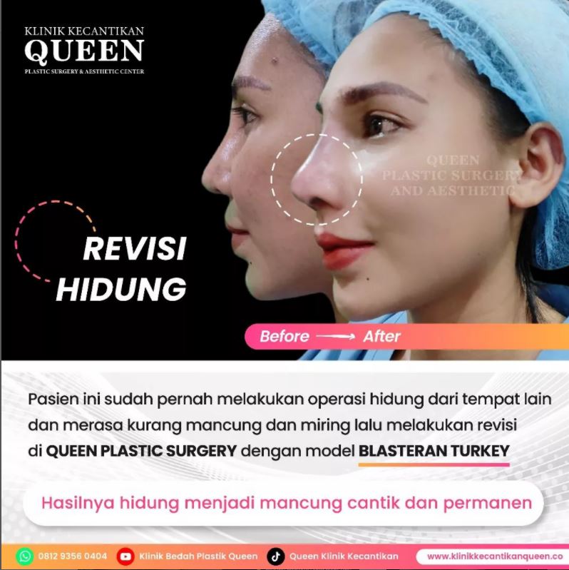 Hasil Rhinoplasty Queen Plastic Surgery, foto 54