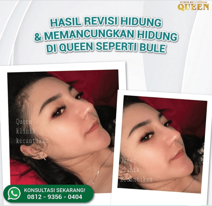 Hasil Rhinoplasty Queen Plastic Surgery, foto 26