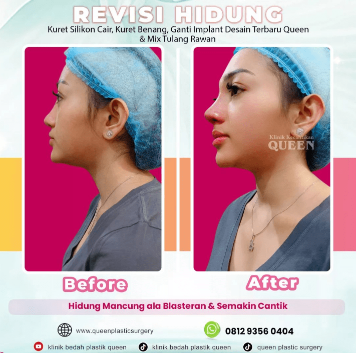 Hasil Rhinoplasty Queen Plastic Surgery, foto 52
