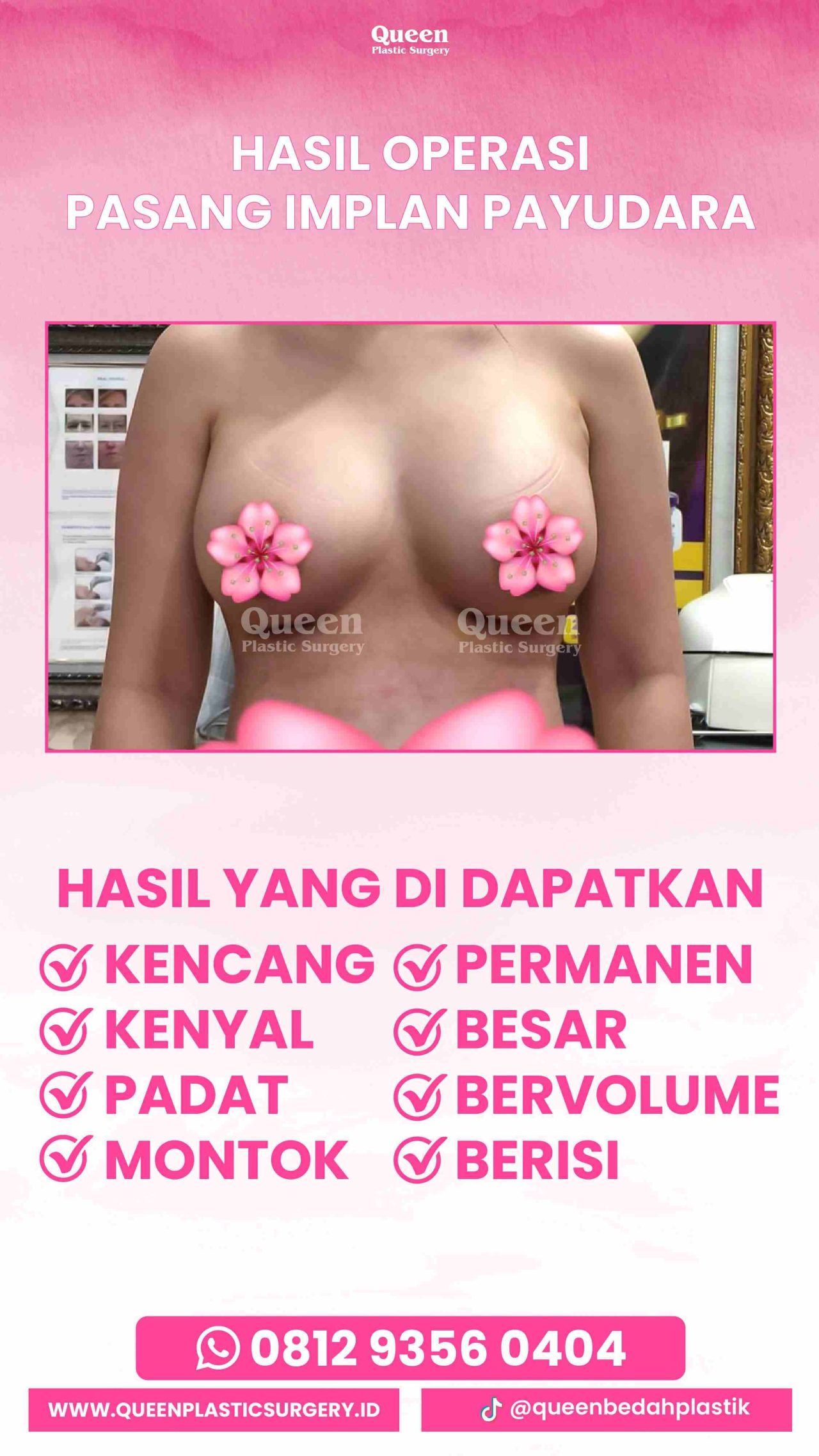 Hasil Breast Implant Queen Plastic Surgery, foto 15