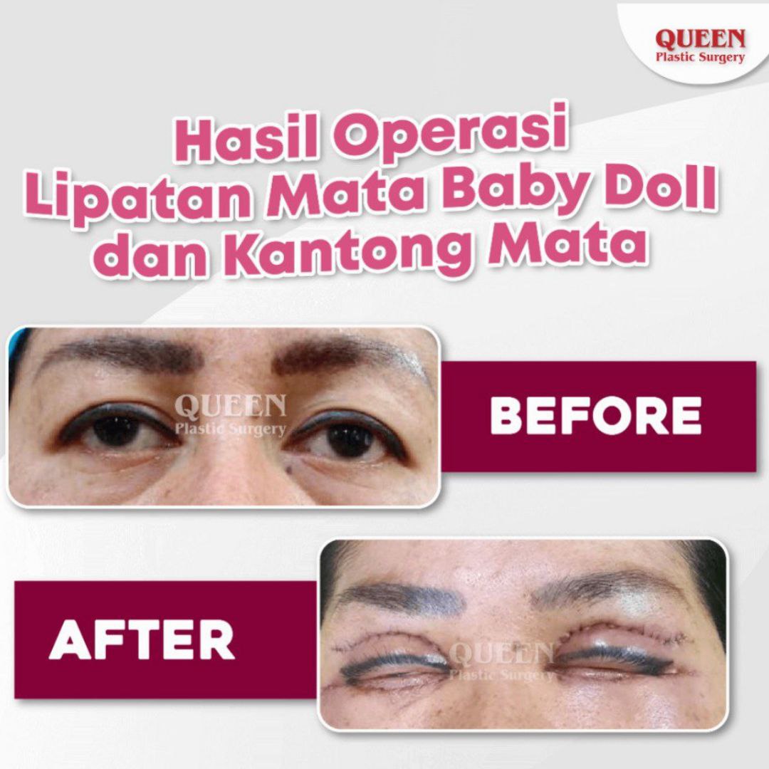 Hasil Blepharoplasty Queen Plastic Surgery, foto 31