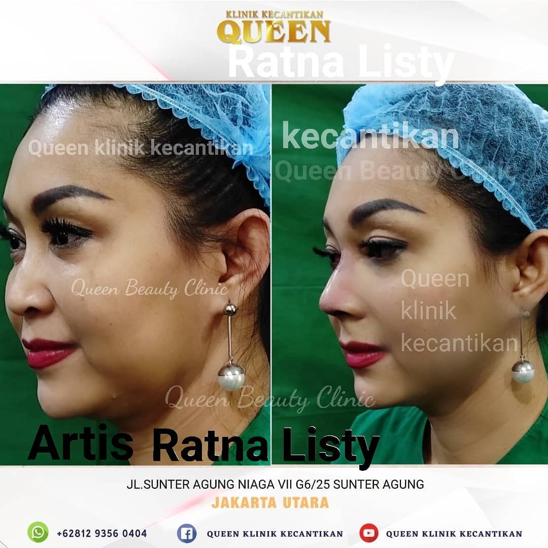 Hasil Rhinoplasty Queen Plastic Surgery, foto 50