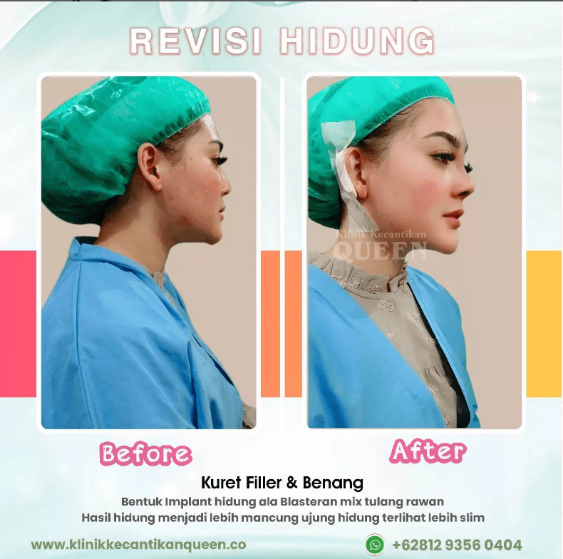Hasil Rhinoplasty Queen Plastic Surgery, foto 62