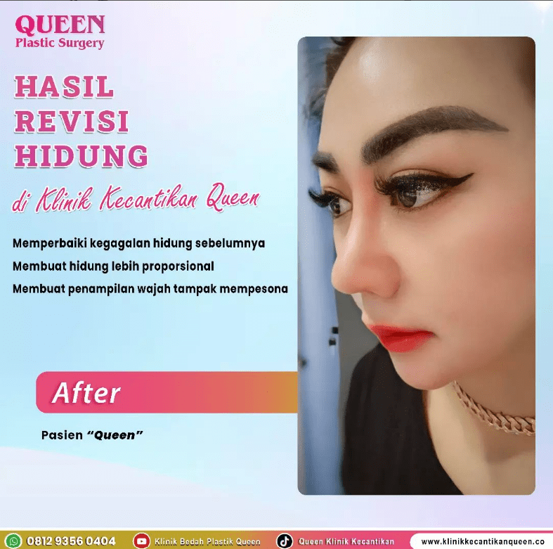 Hasil Rhinoplasty Queen Plastic Surgery, foto 61