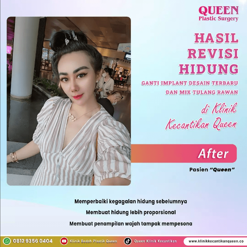 Hasil Rhinoplasty Queen Plastic Surgery, foto 60