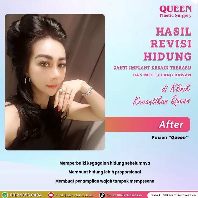 Hasil Rhinoplasty Queen Plastic Surgery, foto 69