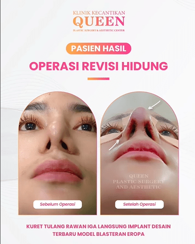 Hasil Rhinoplasty Queen Plastic Surgery, foto 68
