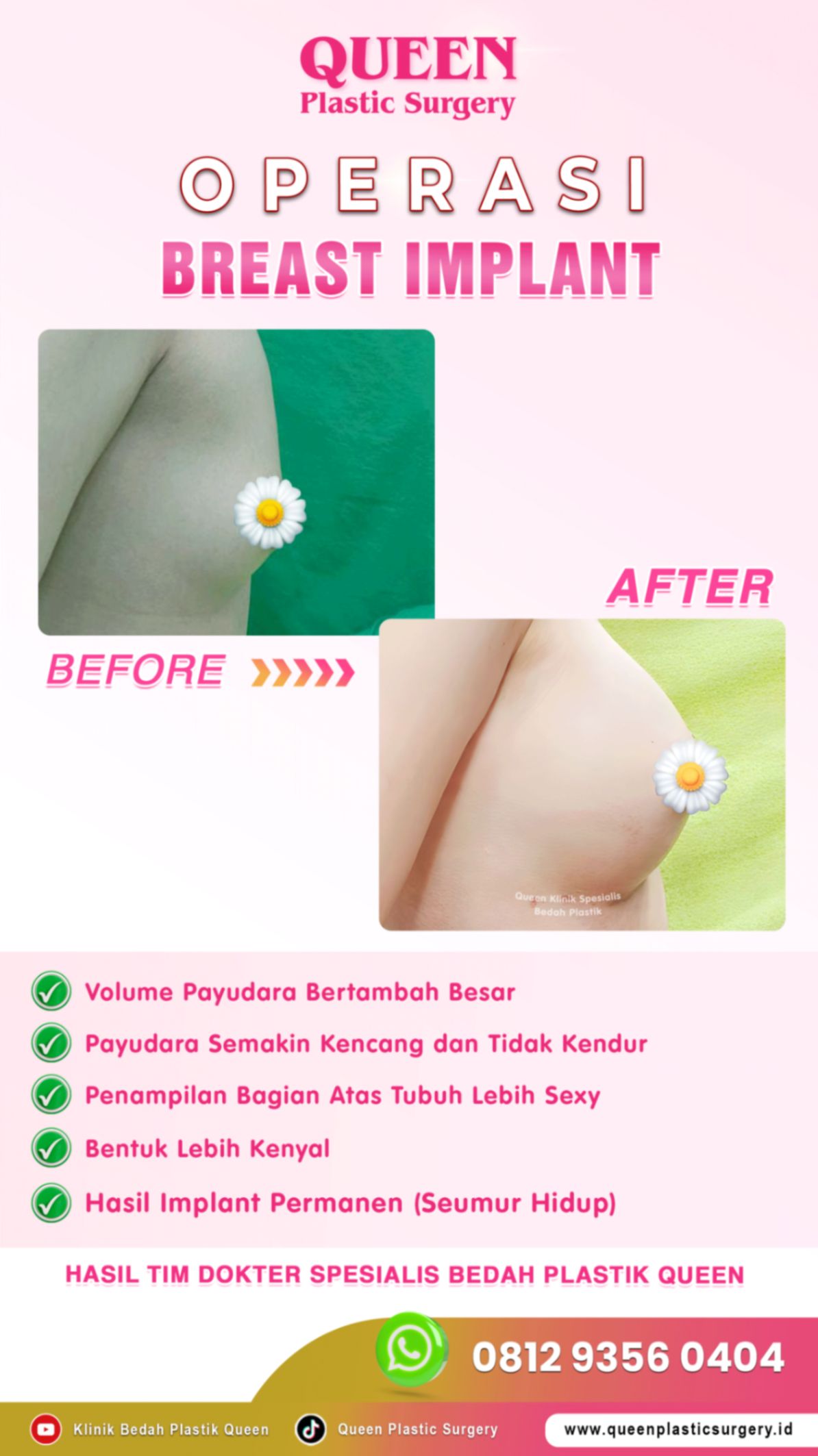 Hasil Breast Implant Queen Plastic Surgery, foto 29