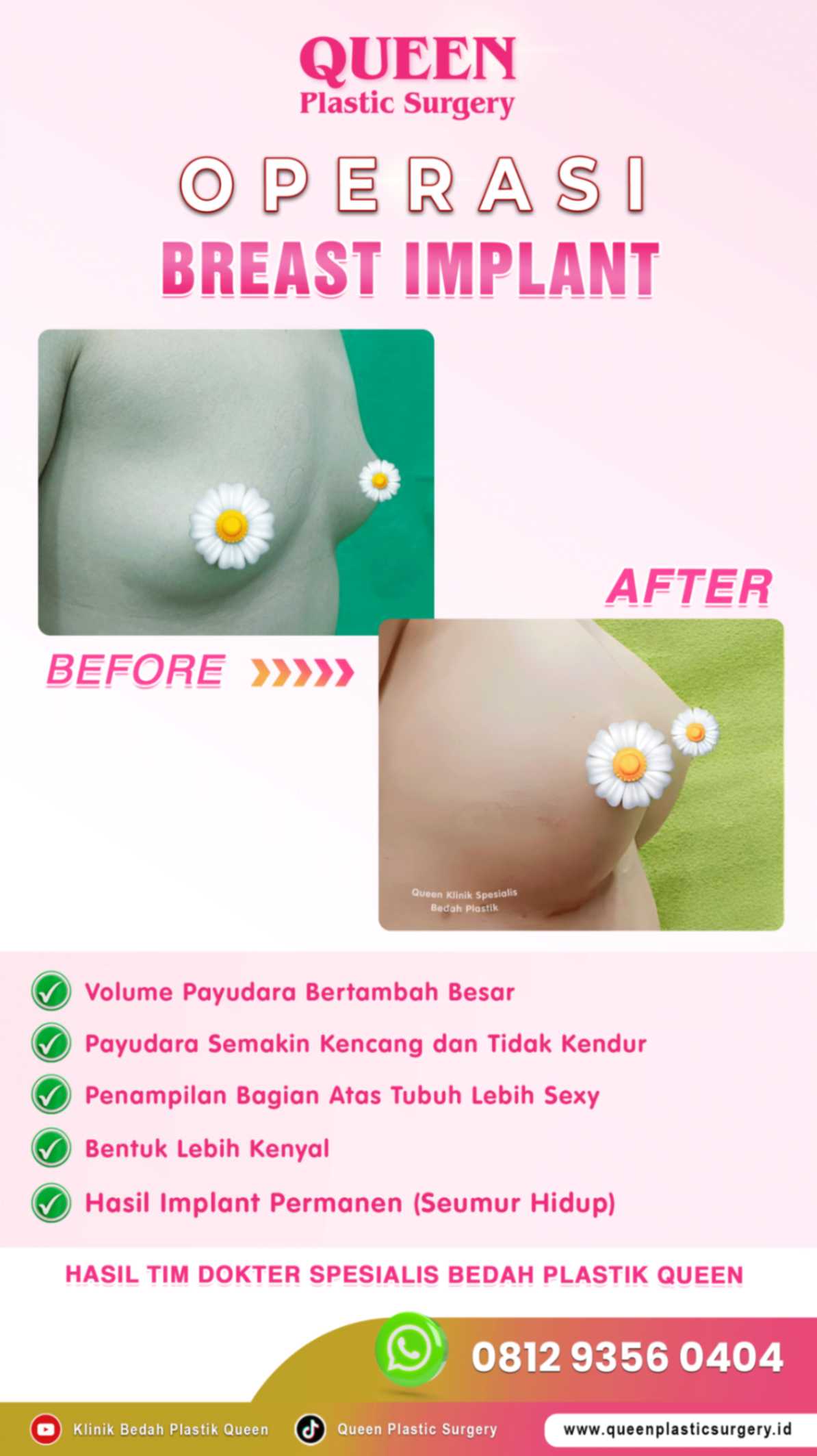 sebelum-&-sesudah-op-breast-implant-queen-003 (1)_batcheditor_fotor-fotor-20240125185238