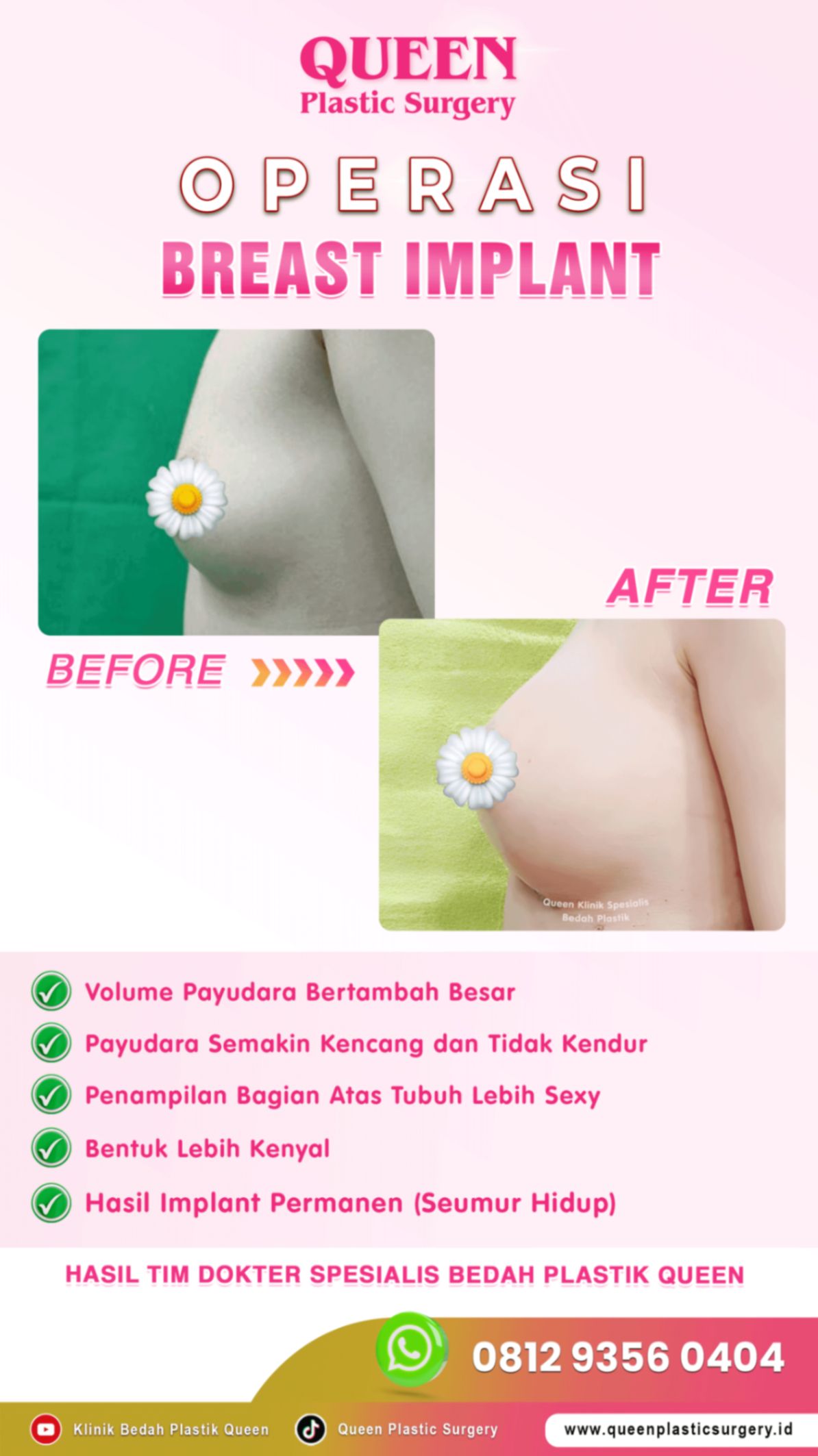 Hasil Breast Implant Queen Plastic Surgery, foto 22