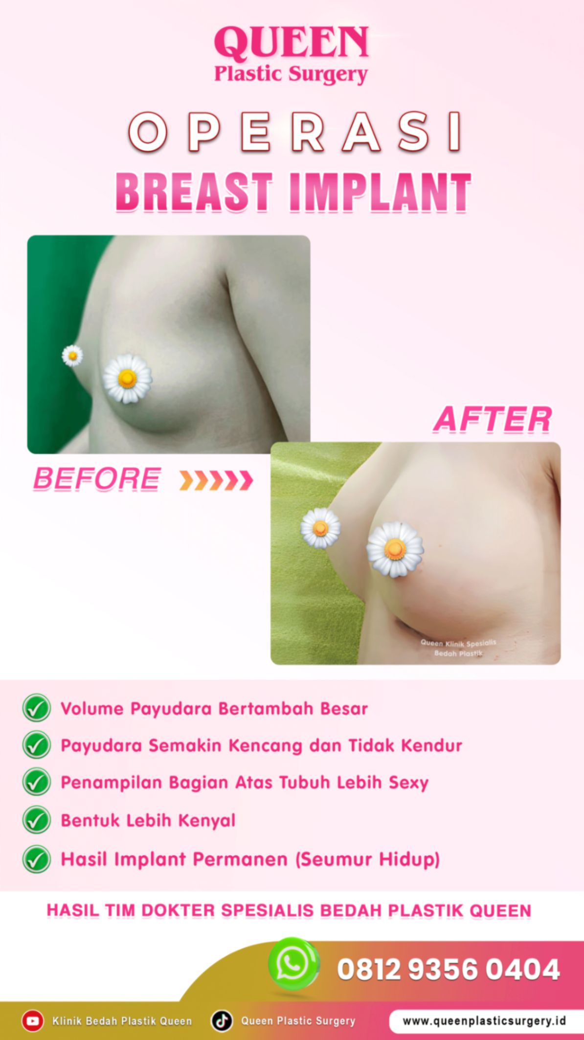 sebelum-&-sesudah-op-breast-implant-queen-005 (1)_batcheditor_fotor-fotor-20240125185519