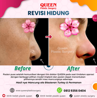 Hasil Rhinoplasty Queen Plastic Surgery, foto 26