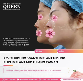 Hasil Rhinoplasty Queen Plastic Surgery, foto 16