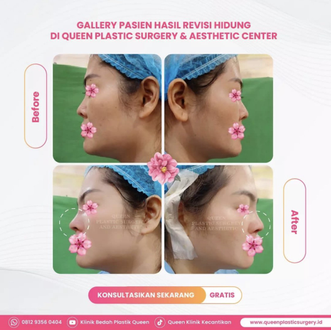Hasil Rhinoplasty Queen Plastic Surgery, foto 17