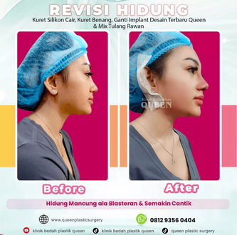 Hasil Rhinoplasty Queen Plastic Surgery, foto 18