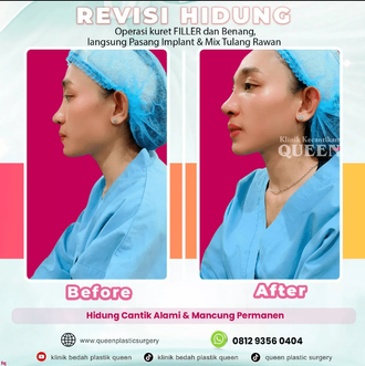 Hasil Rhinoplasty Queen Plastic Surgery, foto 19