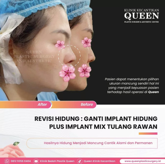 Hasil Rhinoplasty Queen Plastic Surgery, foto 21