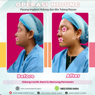 Hasil Rhinoplasty Queen Plastic Surgery, foto 22