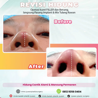 Hasil Rhinoplasty Queen Plastic Surgery, foto 10