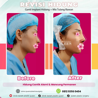 Hasil Rhinoplasty Queen Plastic Surgery, foto 9