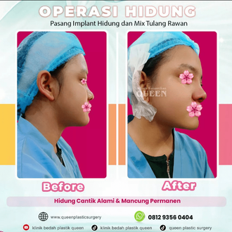 Hasil Rhinoplasty Queen Plastic Surgery, foto 8