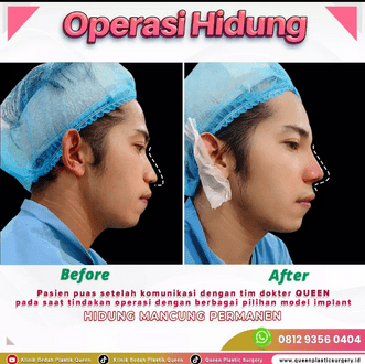 Hasil Rhinoplasty Queen Plastic Surgery, foto 25