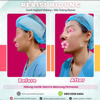 Hasil Rhinoplasty Queen Plastic Surgery, foto 7