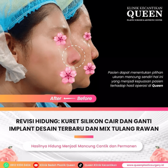 Hasil Rhinoplasty Queen Plastic Surgery, foto 69