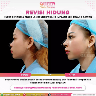 Hasil Rhinoplasty Queen Plastic Surgery, foto 70