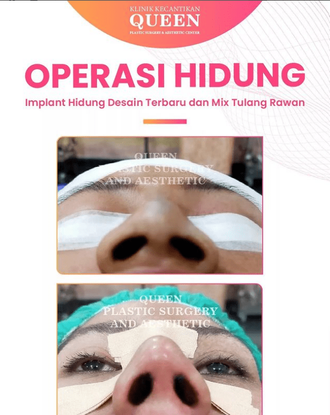 Hasil Rhinoplasty Queen Plastic Surgery, foto 71