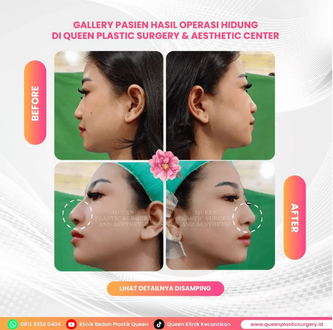 Hasil Rhinoplasty Queen Plastic Surgery, foto 72