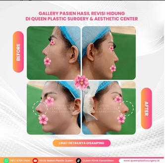 Hasil Rhinoplasty Queen Plastic Surgery, foto 73