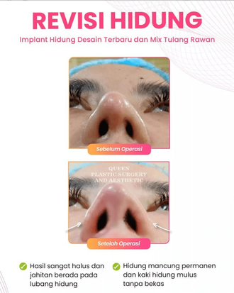 Hasil Rhinoplasty Queen Plastic Surgery, foto 75